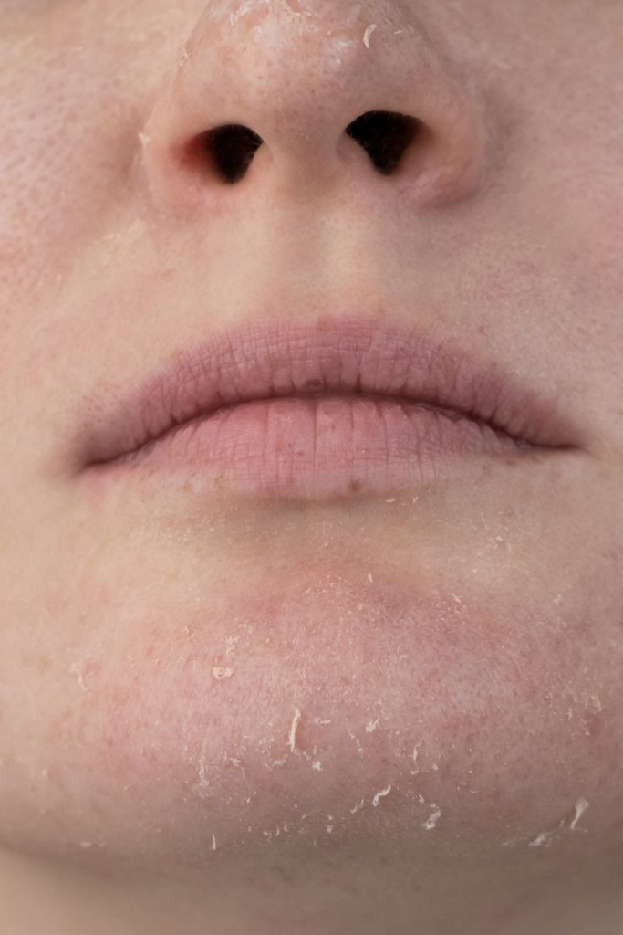 Close-up of dry skin type with visible flaking and rough texture for skincare routine guide. Different Types of Skin