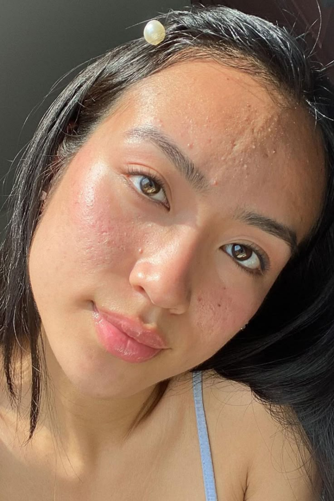 Close-up of combination skin type with oily forehead and dry patches — skincare for different skin types Different Types of Skin