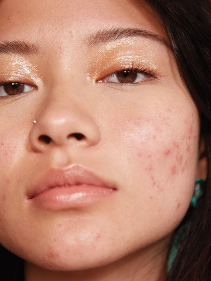 Close-up of acne-prone skin type with blemishes and breakouts — skincare routine for Different Types of Skin