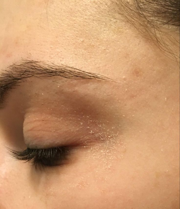 Close-up of dehydrated skin with dry patches and visible oiliness — tips for restoring skin moisture and balance