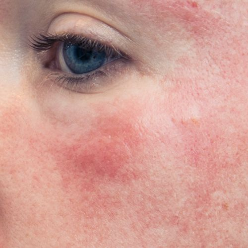 Close-up of sensitive skin with redness and irritation around the eye — best skincare for sensitive skin types